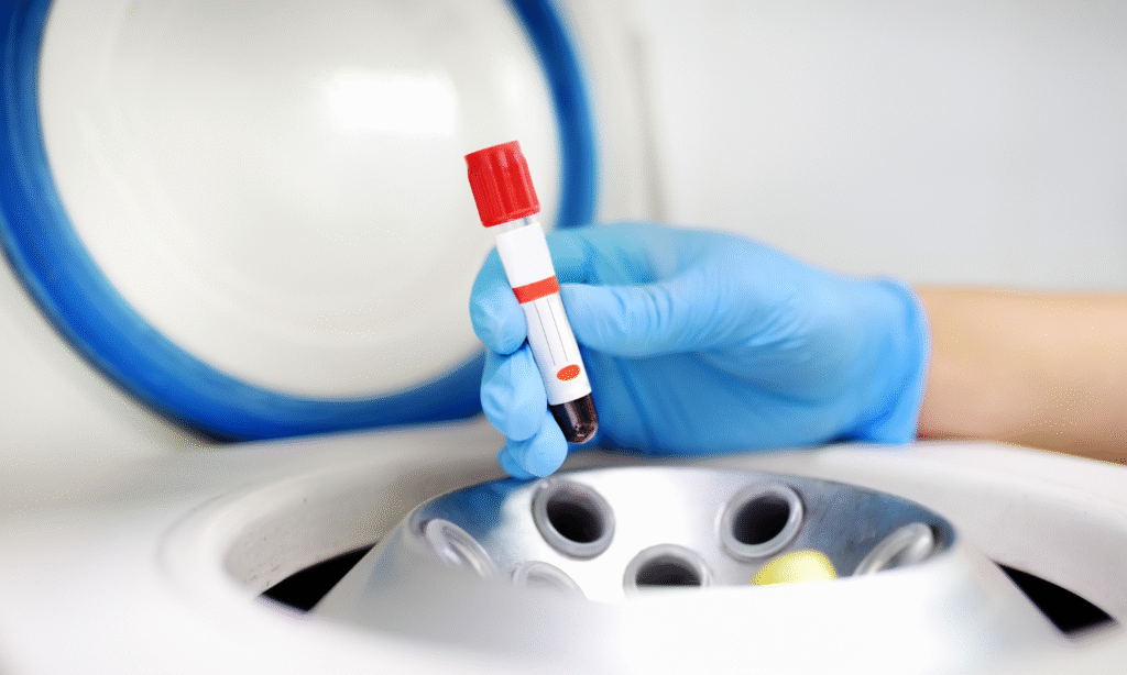 Osocze bogatopłytkowe — jak przygotować się do zabiegu